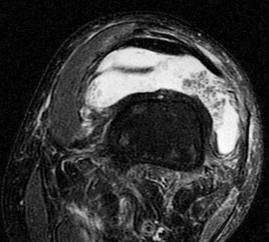 Figure 5 for case Lipoma arborescens